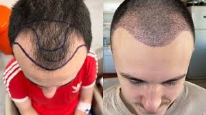 Affordable Hair Transplant UK – Expert Care, Excellent Results