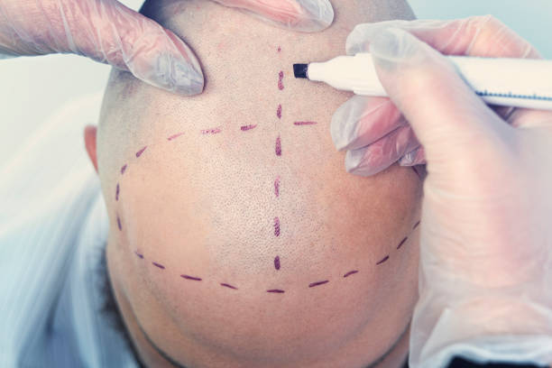 Hair Transplant Turkey Cost: Why Istanbul Is the Global Hub